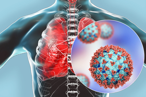 Стало известно, приводит ли «Омикрон» к воспалению легких